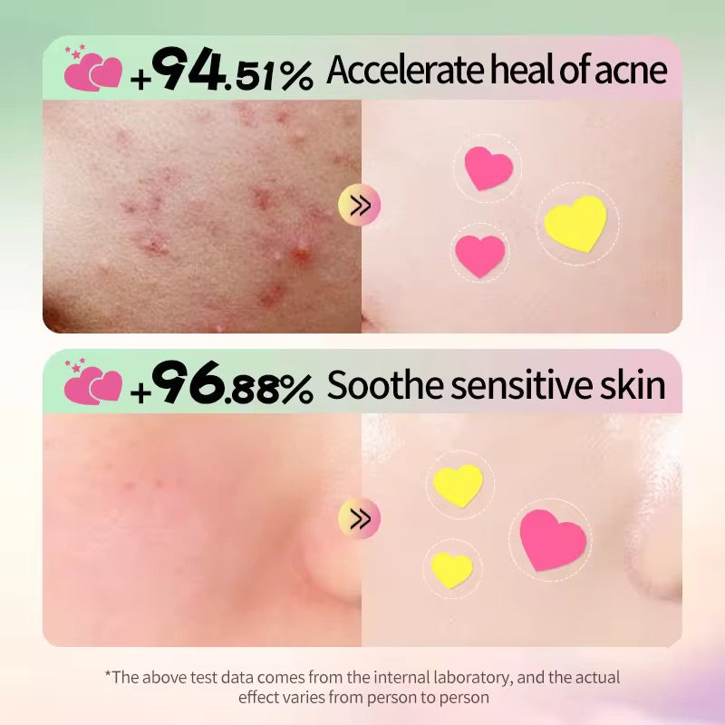 SADOER Hydrocolloid Cleanse Acne Patch - 144 Patches / Bag